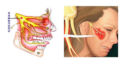 老年人三叉神经痛医治方案